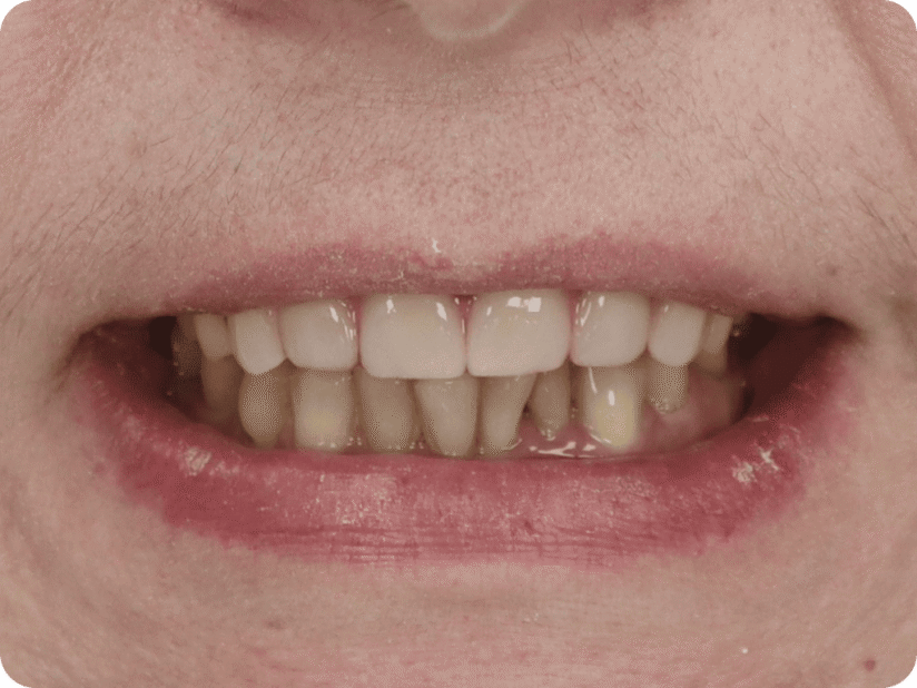 Имплантация All-on-6 