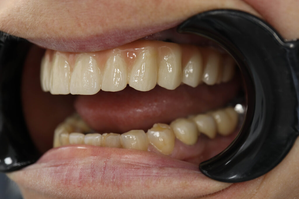 Установка 6-ти дентальных имплантантов Megagen Anyone