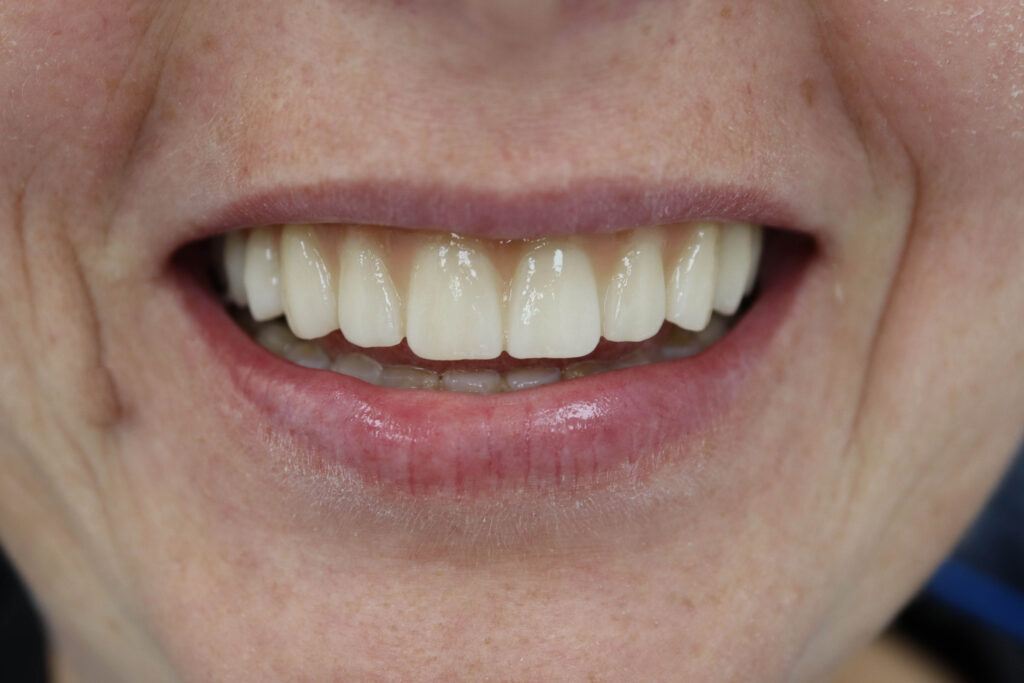 Установка 6-ти дентальных имплантантов Megagen Anyone