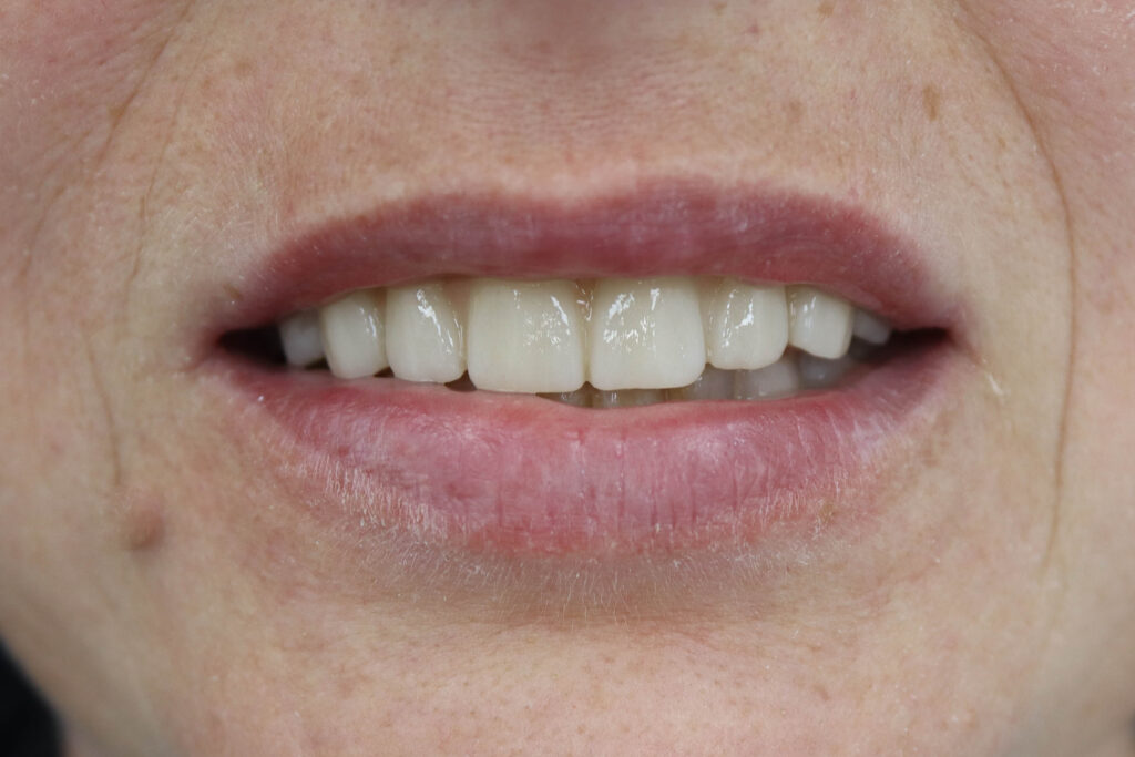 Установка 6-ти дентальных имплантантов Megagen Anyone