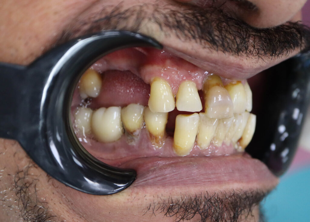 пациент до имплантации