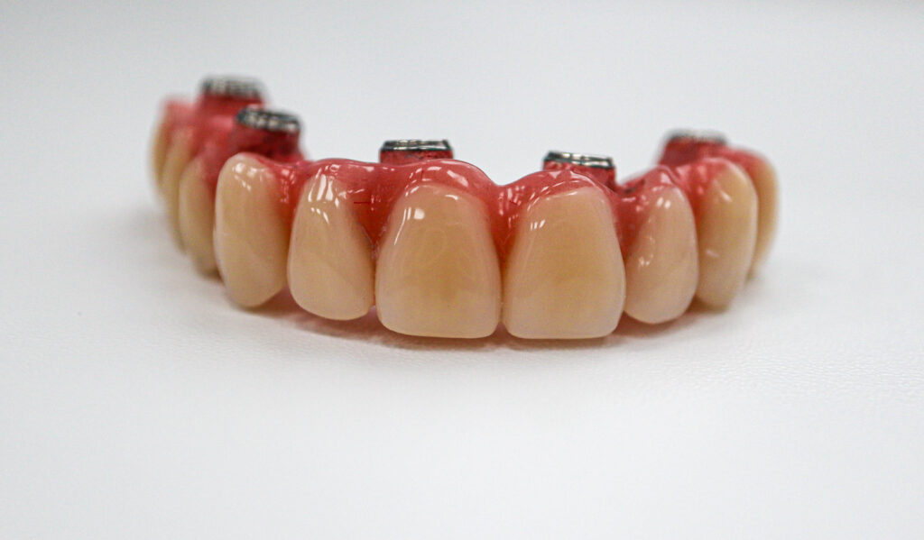 Результат имплантации