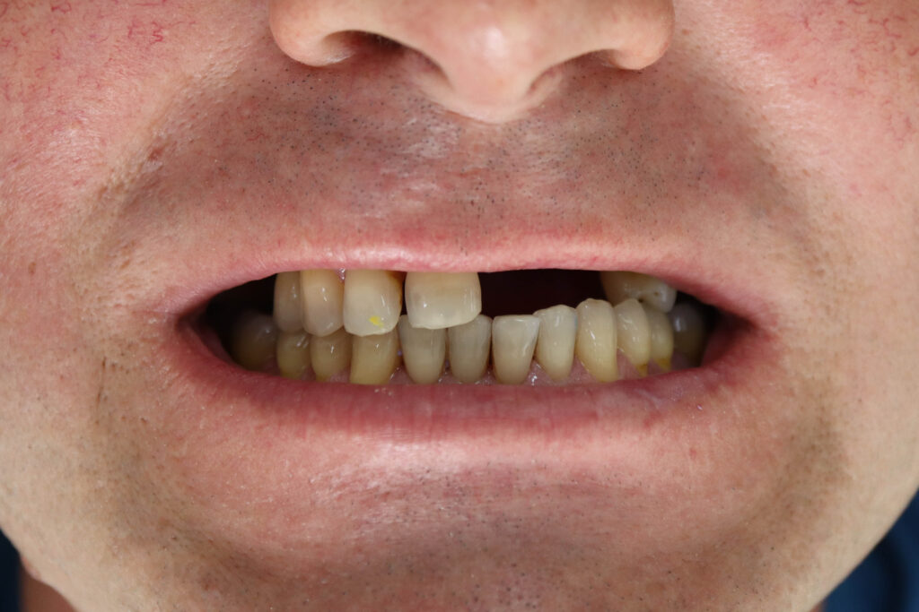 пациент до имплантации