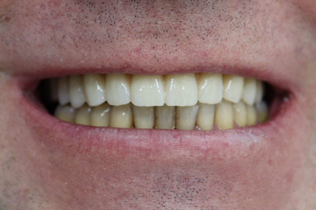 Установка протеза с опорой на дентальные имплантаты Megagen Anyone