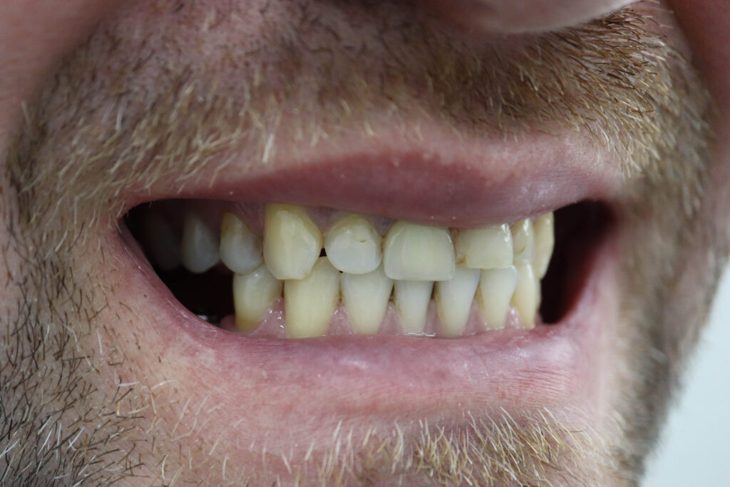 Ситуация до лечения Бутримович