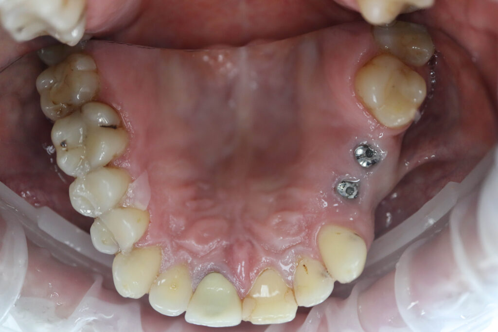 процесс имплантации