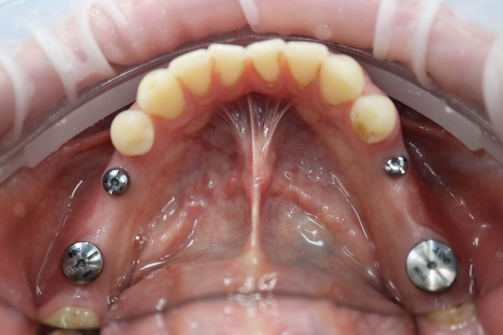 процесс имплантации