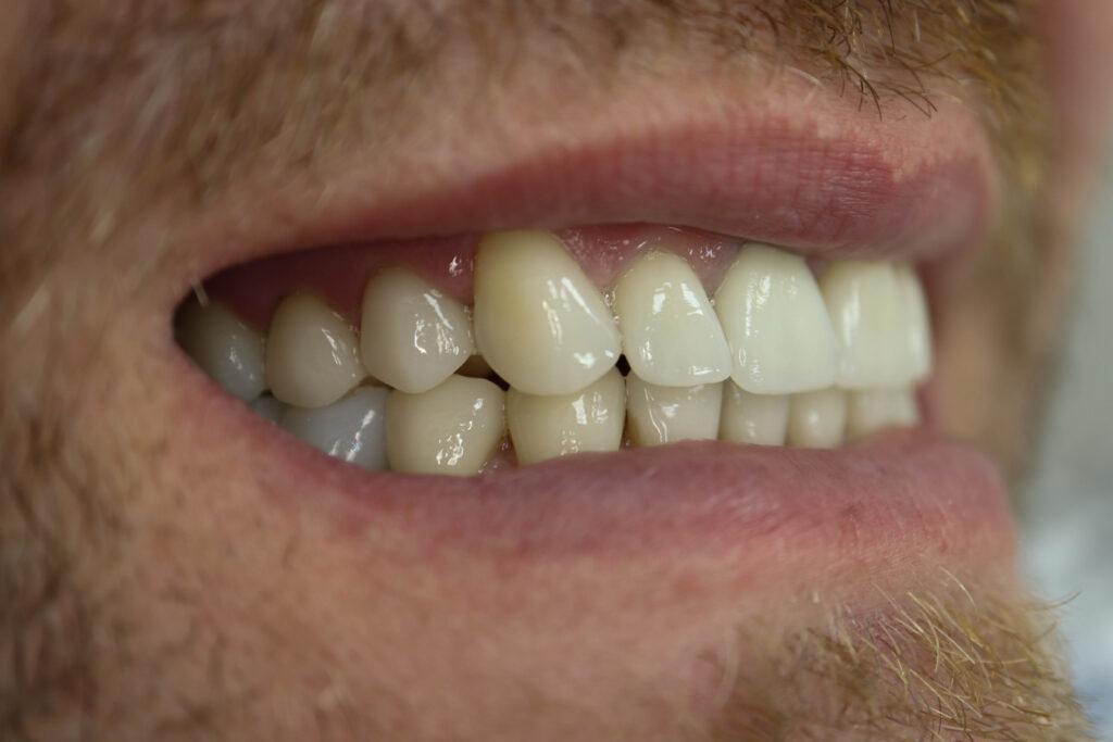 Результат протезирования и имплантации