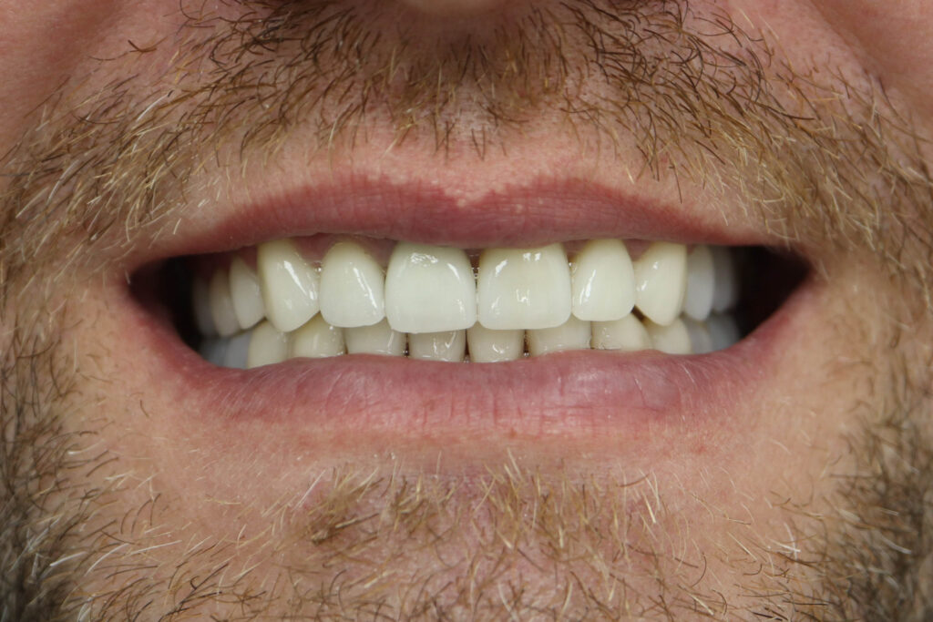 Результат протезирования и имплантации