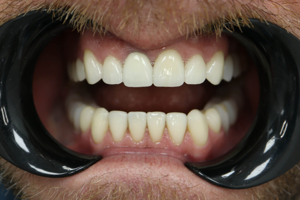 Результат протезирования и имплантации