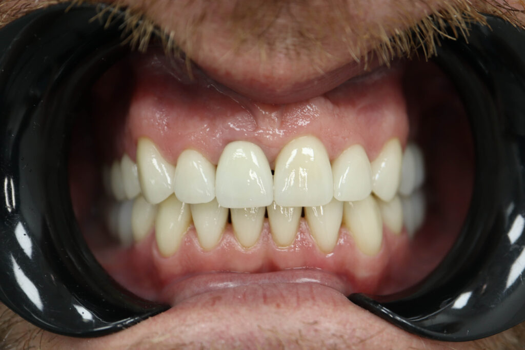 Результат протезирования и имплантации