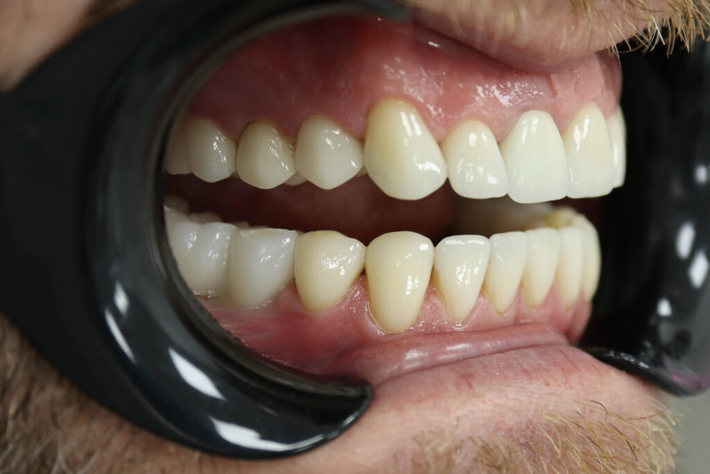 Результат протезирования и имплантации