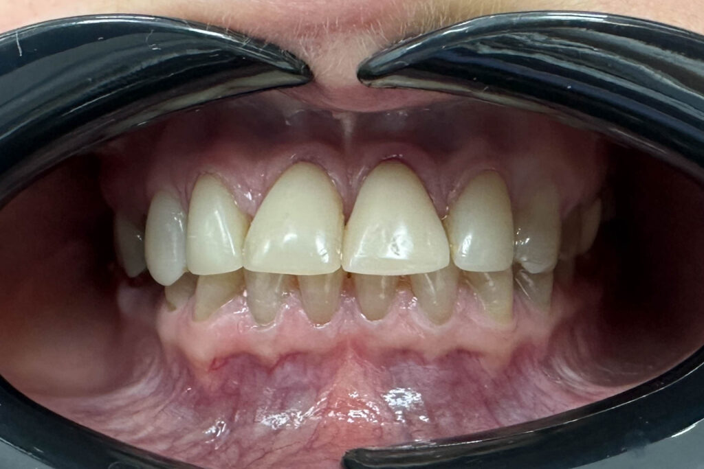 Реставрации Emax Press цвета A1 ДО