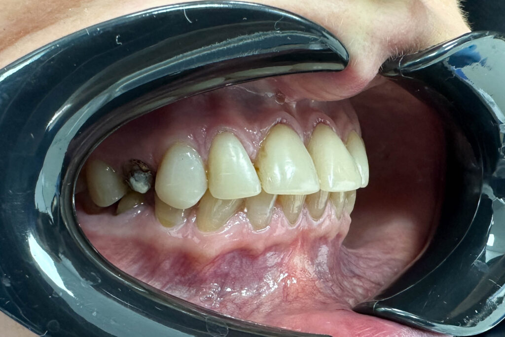 Реставрации Emax Press цвета A1 ДО