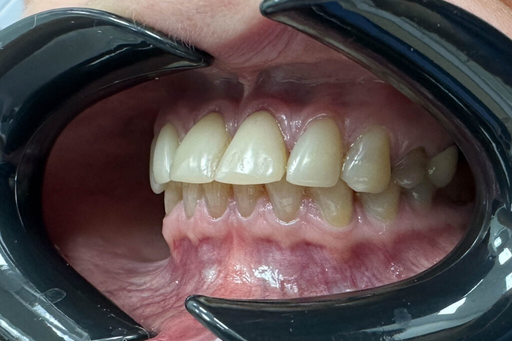 Реставрации Emax Press цвета A1 ДО