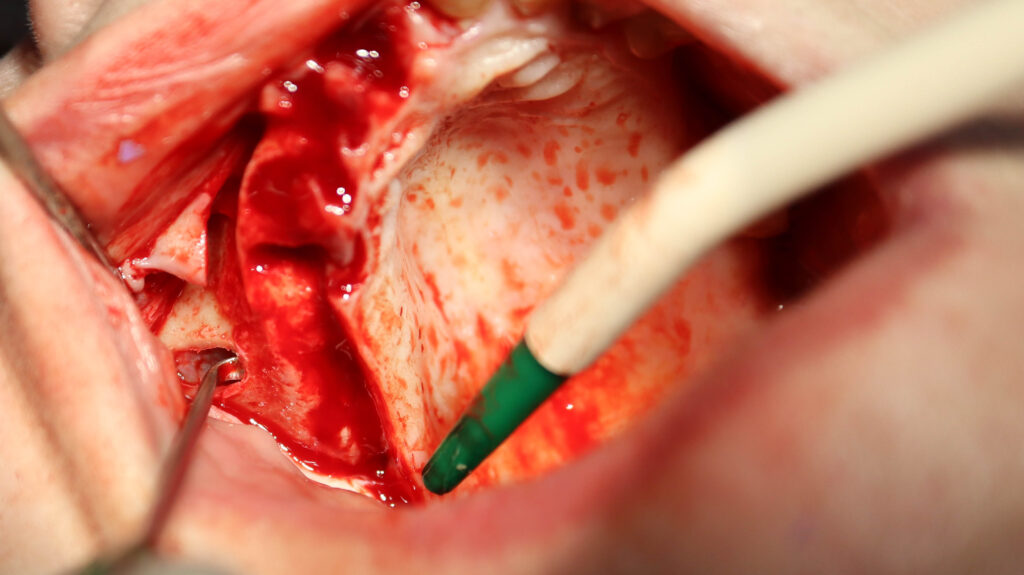 процесс имплантации