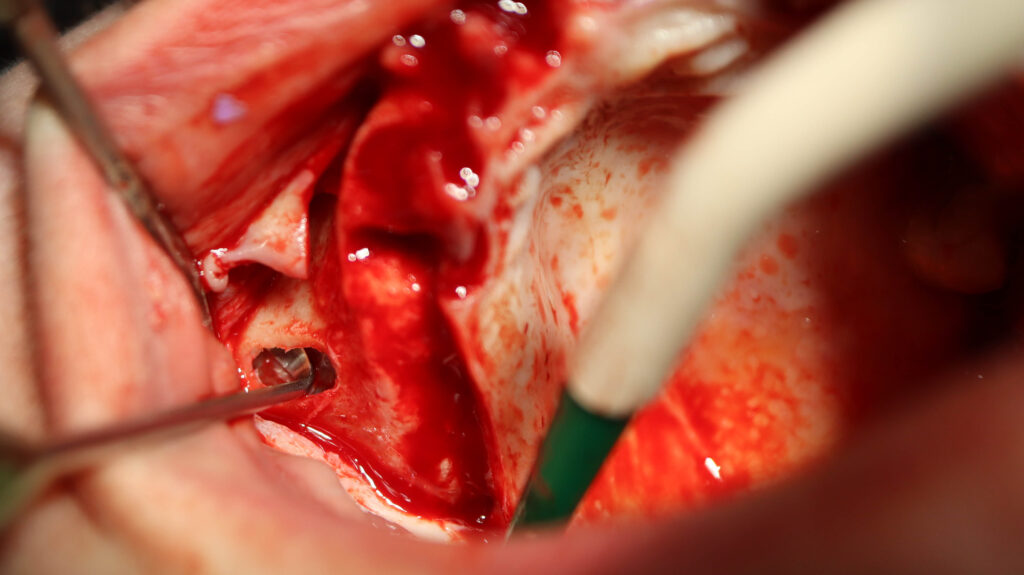 процесс имплантации