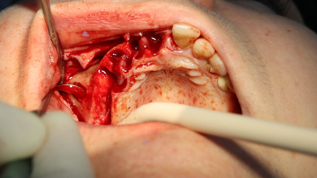 процесс имплантации