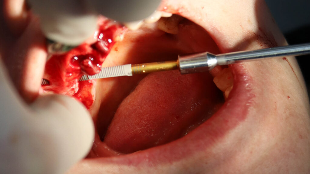 процесс имплантации