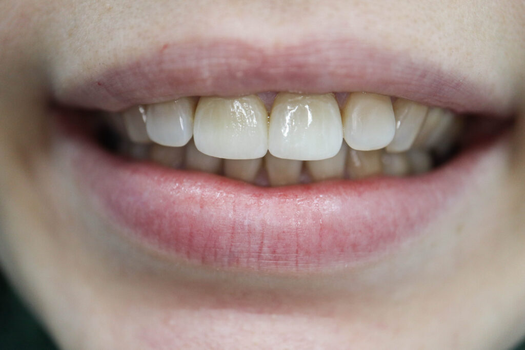 Протезирование керамическими коронками Emax