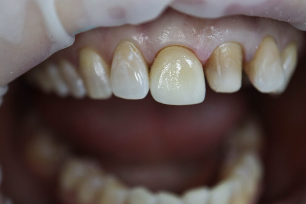 результат протезирования