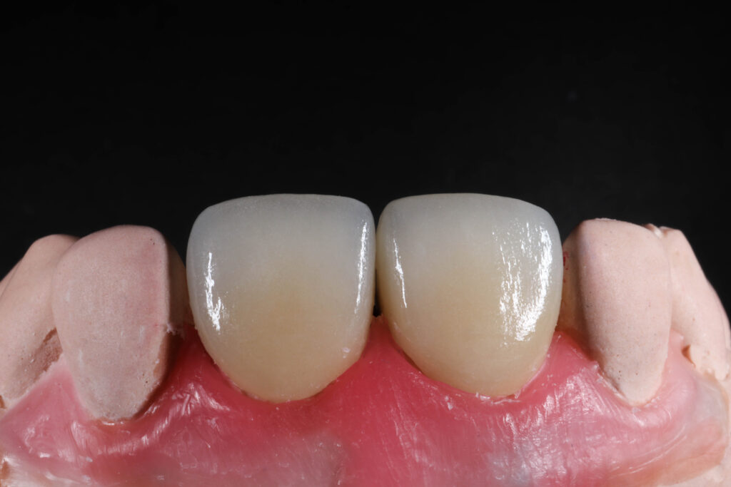 результат протезирования