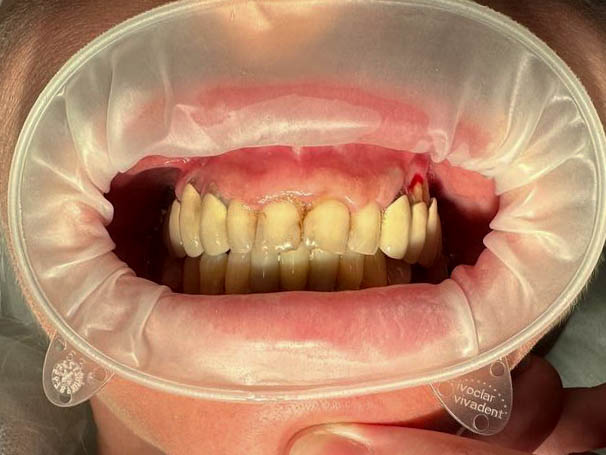 пациент до имплантации