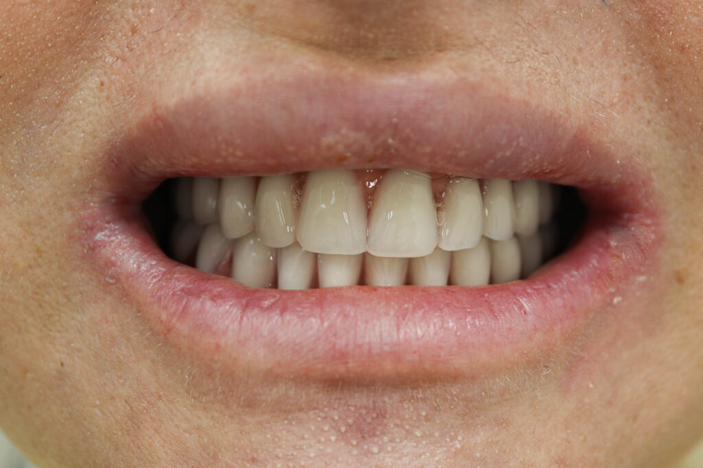 Установка 6 классических имплантатов NeoDent и 3 скуловых имплантата