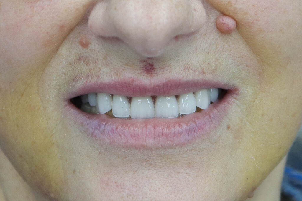 Имплантация All on 6 MegaGen