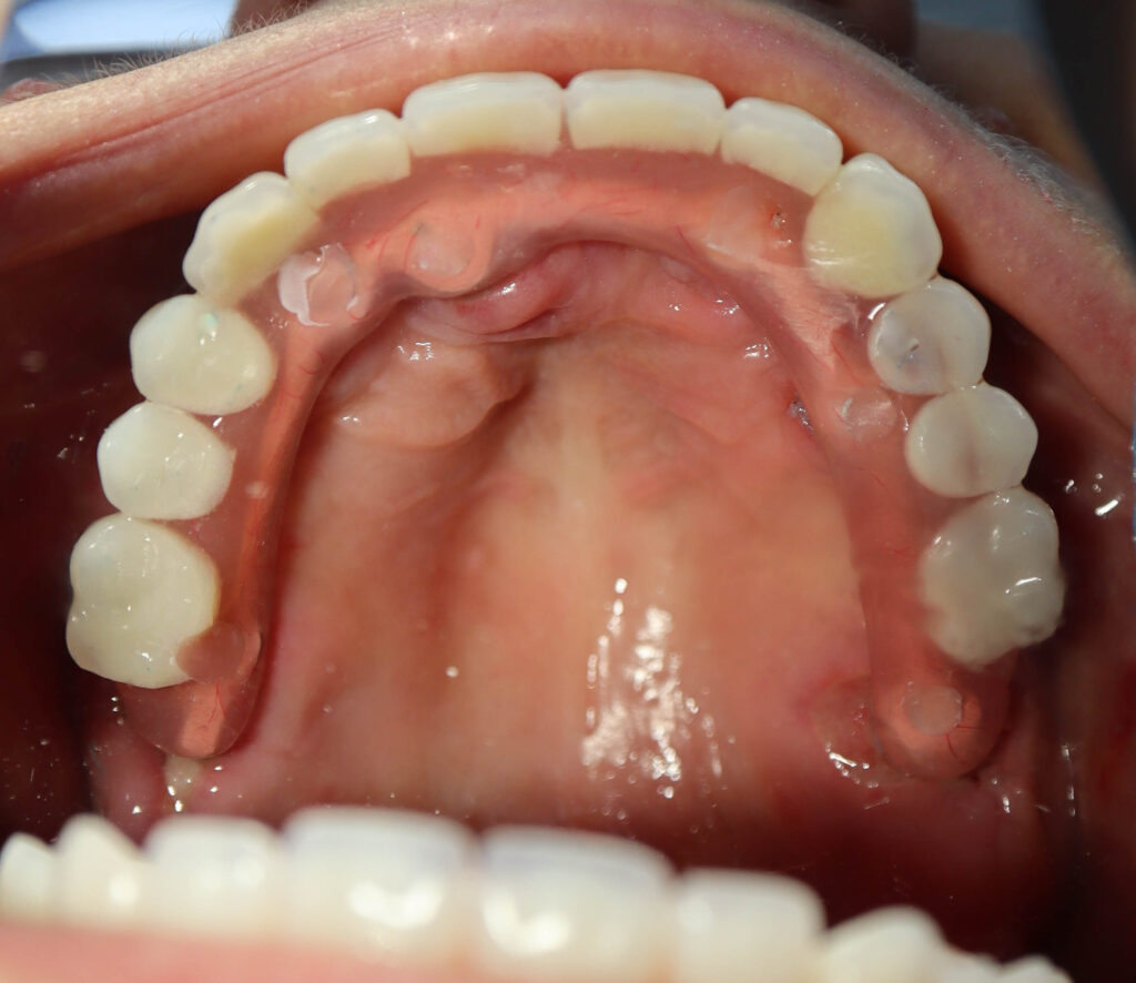 результат имплантации