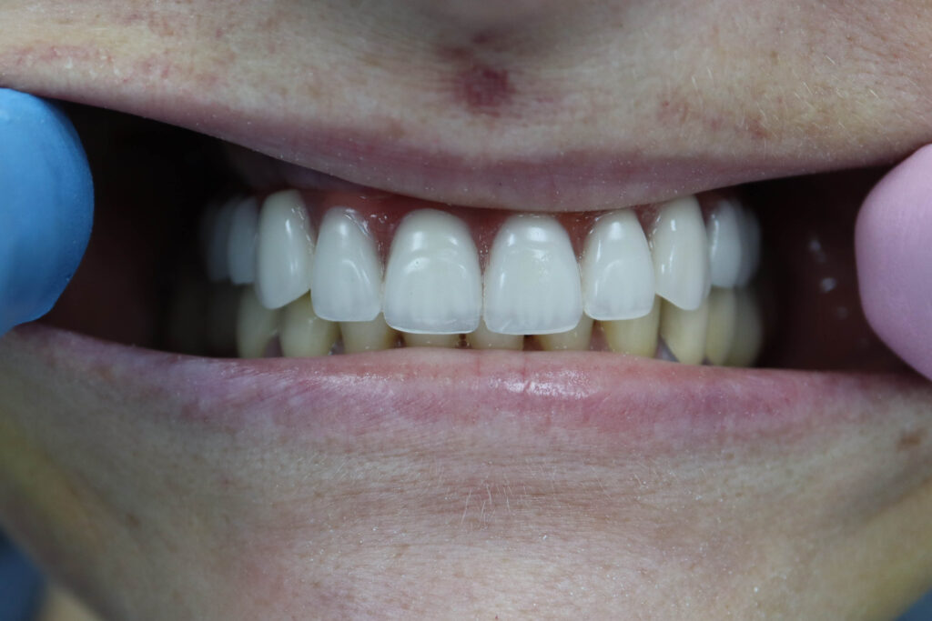 результат имплантации