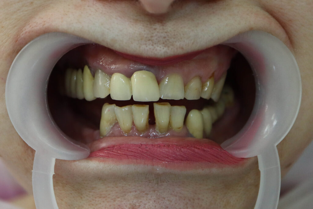 пациент до имплантации