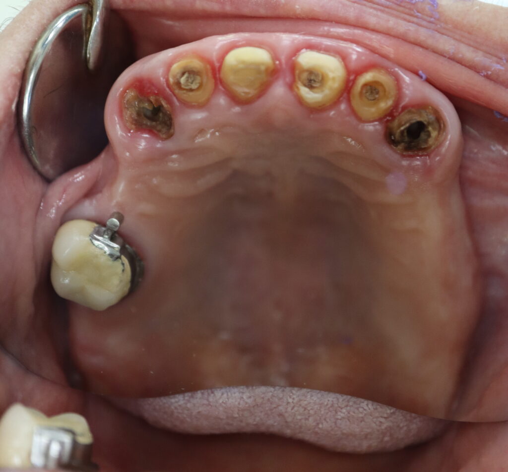 пациент до имплантации