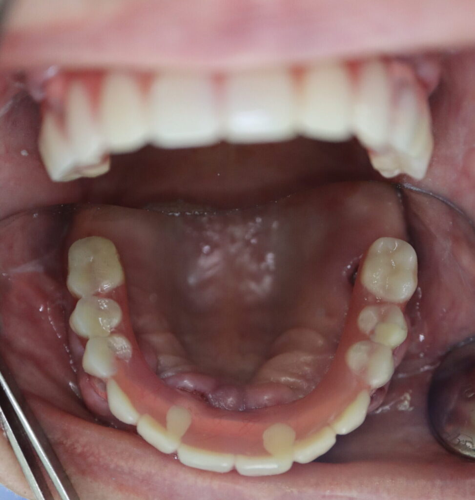 результат имплантации