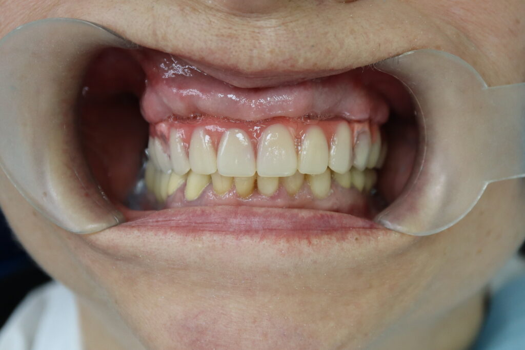 Имплантация по системе All-on-6 + 6 имплантатов Megagen AnyOne