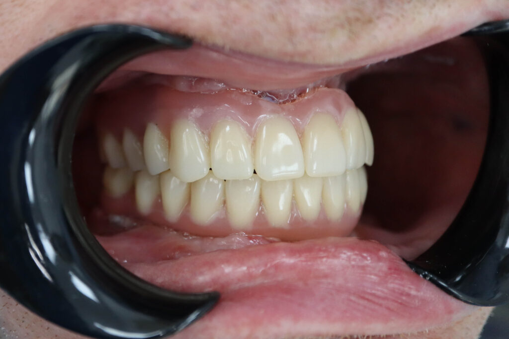 Результат имплантации