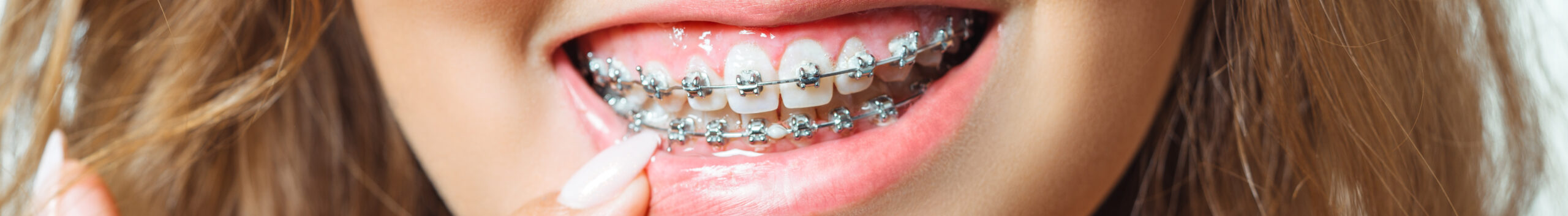 Для чего ставят брекеты?