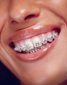 Металлические брекеты