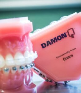 Брекеты Damon
