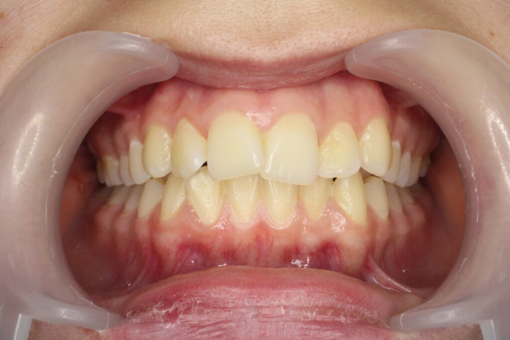 пациент до лечения брекетами