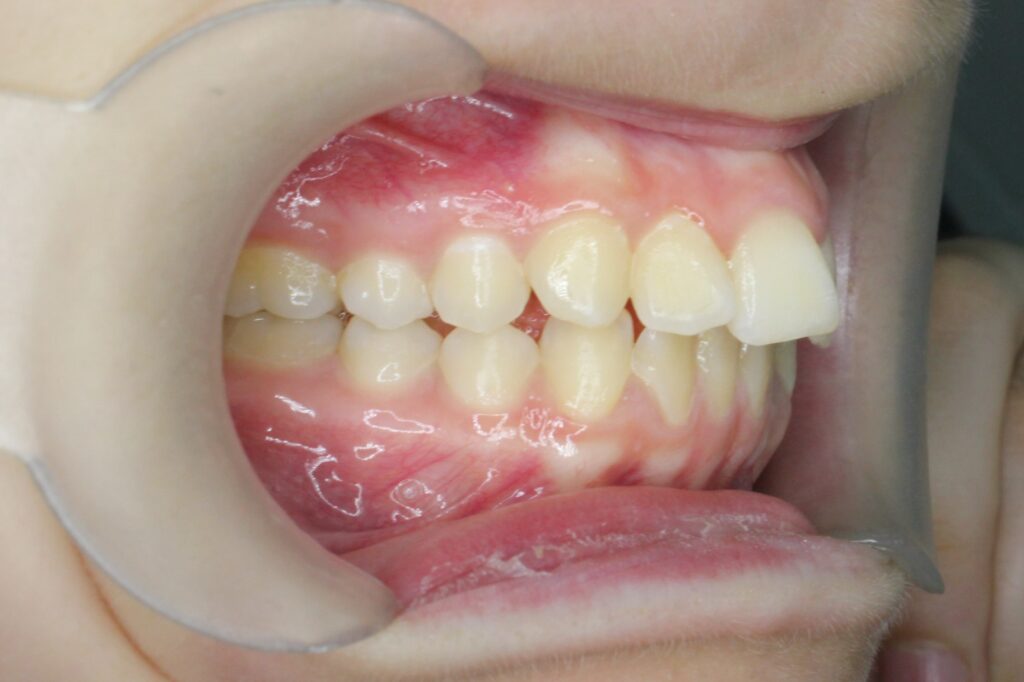 пациент до лечения брекетами