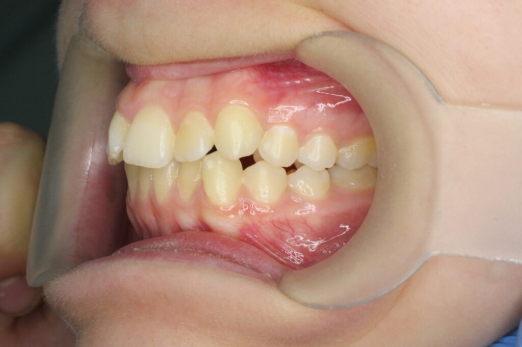 пациент до лечения брекетами