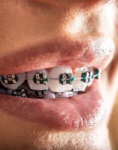 Самолигирующие брекеты 