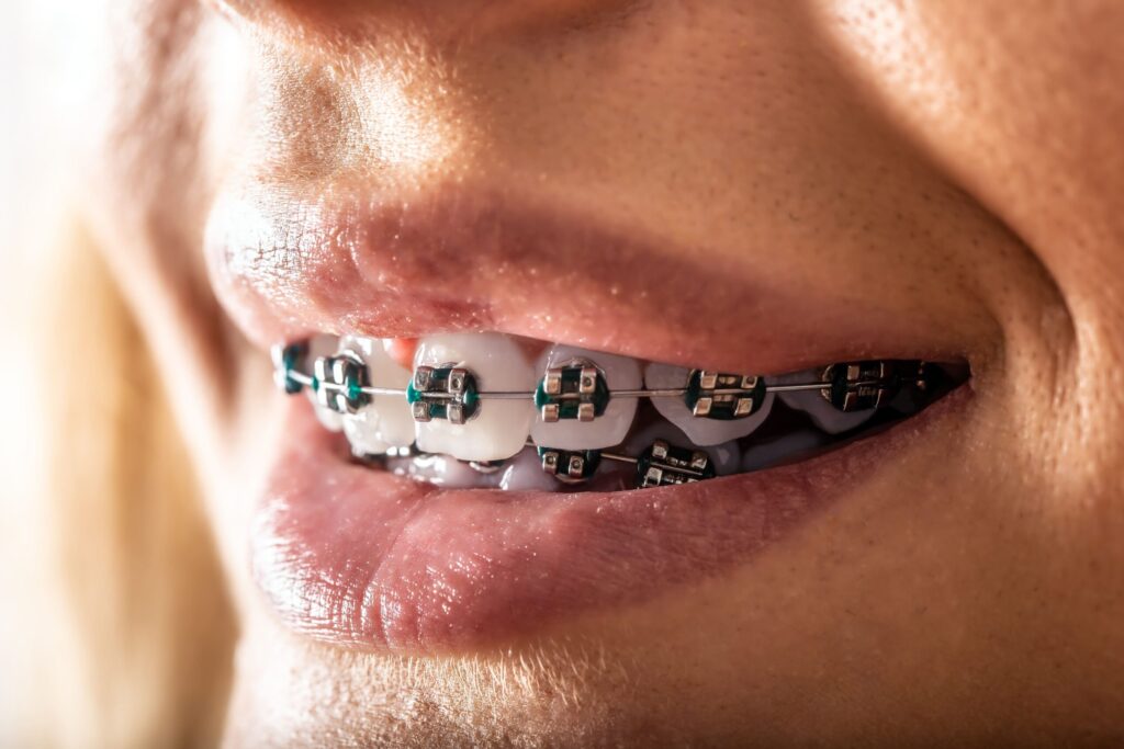 Самолигирующие брекеты