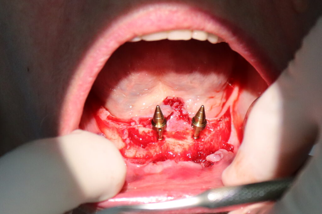 процесс имплантации