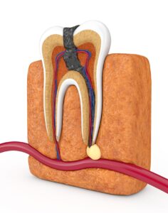 ЛЕЧЕНИЕ КИСТЫ ЗУБА