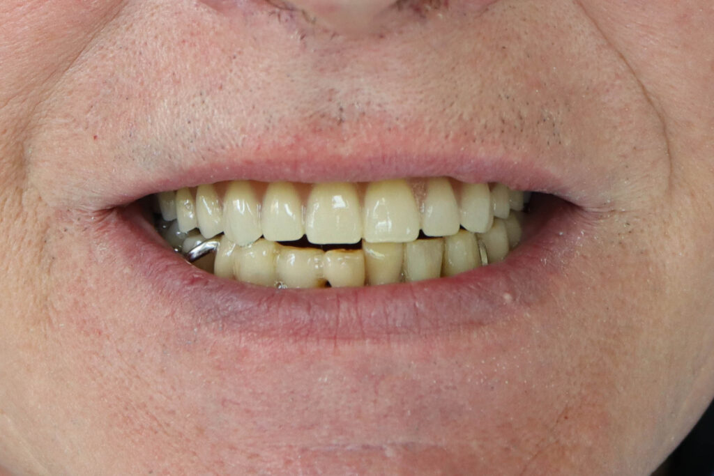 Комплексная имплантация по системе All-on-4 + 4 имплантата Megagen AnyOne