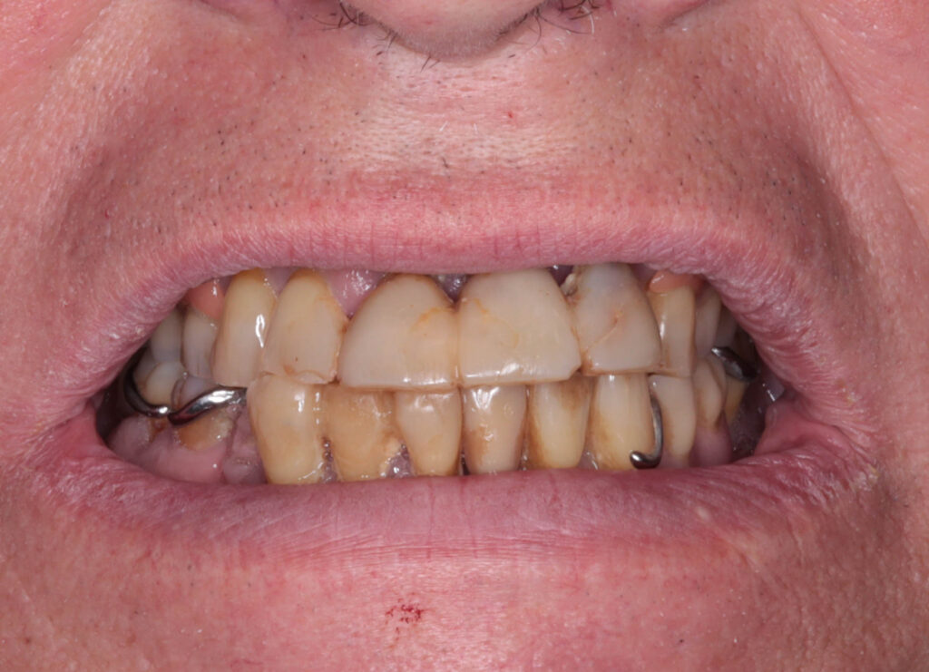 пациент до имплантации