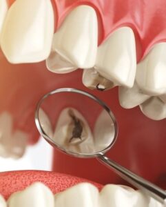 ЛЕЧЕНИЕ КАРИЕСА ЗУБОВ