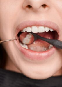 Удаление зуба мудрости